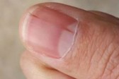 指甲上有竖纹是身体有大病的征兆吗?蚂蚁庄园11.5答案最新