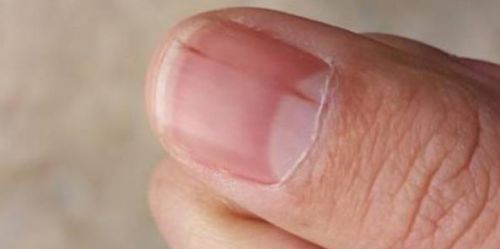 指甲上有竖纹是身体有大病的征兆吗?蚂蚁庄园11.5答案最新
